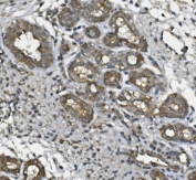 IHC staining of FFPE human breast cancer with ULBP1 antibody. HIER: boil tissue sections in pH8 EDTA for 20 min and allow to cool before testing.