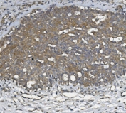 IHC staining of FFPE human breast cancer with ULBP1 antibody. HIER: boil tissue sections in pH8 EDTA for 20 min and allow to cool before testing.
