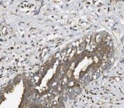 IHC staining of FFPE human breast cancer with UNG antibody. HIER: boil tissue sections in pH8 EDTA for 20 min and allow to cool before testing.