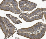 IHC staining of FFPE human rectal cancer with UNG antibody. HIER: boil tissue sections in pH8 EDTA for 20 min and allow to cool before testing.