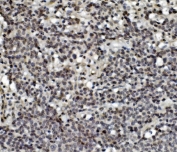 IHC staining of FFPE human lung cancer with MCPIP1 antibody. HIER: boil tissue sections in pH8 EDTA for 20 min and allow to cool before testing.
