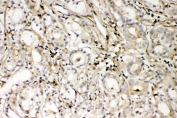 IHC staining of FFPE human prostate cancer with S100A4 antibody. HIER: boil tissue sections in pH8 EDTA for 20 min and allow to cool before testing.