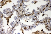 IHC staining of FFPE human lung cancer with S100A4 antibody. HIER: boil tissue sections in pH8 EDTA for 20 min and allow to cool before testing.