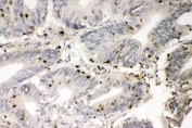 IHC staining of FFPE human intestinal cancer with S100A4 antibody. HIER: boil tissue sections in pH8 EDTA for 20 min and allow to cool before testing.