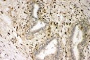 IHC staining of FFPE human breast cancer with S100A4 antibody. HIER: boil tissue sections in pH8 EDTA for 20 min and allow to cool before testing.