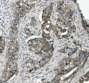 IHC staining of FFPE human breast cancer with ABCC5 antibody. HIER: boil tissue sections in pH8 EDTA for 20 min and allow to cool before testing.
