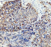 IHC staining of FFPE human liver cancer tissue with ACADS antibody. HIER: boil tissue sections in pH8 EDTA for 20 min and allow to cool before testing.