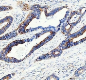 IHC staining of FFPE human colon cancer tissue with ACADS antibody. HIER: boil tissue sections in pH8 EDTA for 20 min and allow to cool before testing.