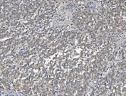 IHC staining of FFPE human liver cancer with Afamin antibody. HIER: boil tissue sections in pH8 EDTA for 20 min and allow to cool before testing.