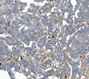 IHC staining of FFPE human ovarian cancer with Afamin antibody. HIER: boil tissue sections in pH8 EDTA for 20 min and allow to cool before testing.