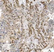 IHC staining of FFPE human liver cancer with CCR2 antibody. HIER: boil tissue sections in pH8 EDTA for 20 min and allow to cool before testing.