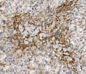 IHC staining of FFPE human liver cancer with CCR2 antibody. HIER: boil tissue sections in pH8 EDTA for 20 min and allow to cool before testing.