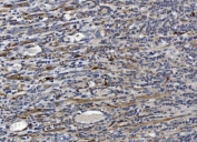 IHC staining of FFPE human gastric cancer with CRYAB antibody. HIER: boil tissue sections in pH8 EDTA for 20 min and allow to cool before testing.