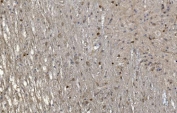 IHC staining of FFPE human glioma with CRYAB antibody. HIER: boil tissue sections in pH8 EDTA for 20 min and allow to cool before testing.