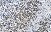 IHC staining of FFPE human gastric cancer with DNM1L antibody. HIER: boil tissue sections in pH8 EDTA for 20 min and allow to cool before testing.