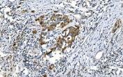 IHC staining of FFPE human bladder cancer with DNM1L antibody. HIER: boil tissue sections in pH8 EDTA for 20 min and allow to cool before testing.