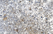 IHC staining of FFPE human liver cancer with DNM1L antibody. HIER: boil tissue sections in pH8 EDTA for 20 min and allow to cool before testing.