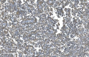 IHC staining of FFPE human melanoma with DNM1L antibody. HIER: boil tissue sections in pH8 EDTA for 20 min and allow to cool before testing.