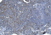 IHC staining of FFPE human lung cancer with DNM1L antibody. HIER: boil tissue sections in pH8 EDTA for 20 min and allow to cool before testing.