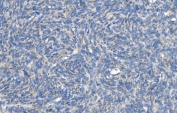IHC staining of FFPE human skin cancer with DNM1L antibody. HIER: boil tissue sections in pH8 EDTA for 20 min and allow to cool before testing.