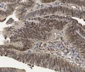 IHC staining of FFPE human rectal cancer with FOXP1 antibody. HIER: boil tissue sections in pH8 EDTA for 20 min and allow to cool before testing.