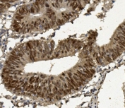 IHC staining of FFPE human rectal cancer with FOXP1 antibody. HIER: boil tissue sections in pH8 EDTA for 20 min and allow to cool before testing.