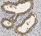 IHC staining of FFPE human breast cancer with FOXP1 antibody. HIER: boil tissue sections in pH8 EDTA for 20 min and allow to cool before testing.
