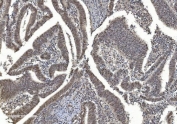 IHC staining of FFPE human rectal cancer with HDAC5 antibody. HIER: boil tissue sections in pH8 EDTA for 20 min and allow to cool before testing.