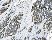 IHC staining of FFPE human ovarian cancer with HOXD11 antibody. HIER: boil tissue sections in pH8 EDTA for 20 min and allow to cool before testing.