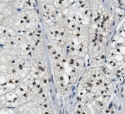 IHC staining of FFPE human adrenal carcinoma with LSM2 antibody. HIER: boil tissue sections in pH8 EDTA for 20 min and allow to cool before testing.