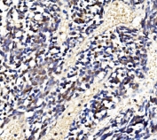 IHC staining of FFPE human lung cancer with LSM2 antibody. HIER: boil tissue sections in pH8 EDTA for 20 min and allow to cool before testing.