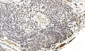 IHC staining of FFPE human rectal cancer with LSM2 antibody. HIER: boil tissue sections in pH8 EDTA for 20 min and allow to cool before testing.