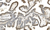 IHC staining of FFPE human thyroid cancer with LSM2 antibody. HIER: boil tissue sections in pH8 EDTA for 20 min and allow to cool before testing.