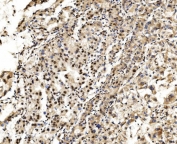 IHC staining of FFPE human liver cancer with LSM2 antibody. HIER: boil tissue sections in pH8 EDTA for 20 min and allow to cool before testing.