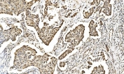 IHC staining of FFPE human breast cancer with LSM2 antibody. HIER: boil tissue sections in pH8 EDTA for 20 min and allow to cool before testing.