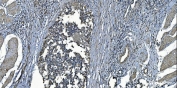 IHC staining of FFPE human bladder cancer with MCU antibody. HIER: boil tissue sections in pH8 EDTA for 20 min and allow to cool before testing.