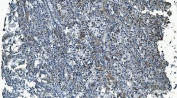 IHC staining of FFPE human liver cancer with MCU antibody. HIER: boil tissue sections in pH8 EDTA for 20 min and allow to cool before testing.