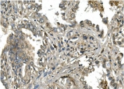 IHC staining of FFPE human lung cancer with MESP2 antibody. HIER: boil tissue sections in pH8 EDTA for 20 min and allow to cool before testing.