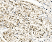 IHC staining of FFPE human liver cancer with SLC25A1 antibody. HIER: boil tissue sections in pH8 EDTA for 20 min and allow to cool before testing.
