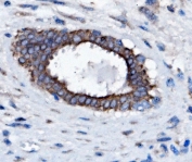 IHC staining of FFPE human breast cancer with SLC25A1 antibody. HIER: boil tissue sections in pH8 EDTA for 20 min and allow to cool before testing.