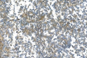 IHC staining of FFPE human melanoma with DR6 antibody. HIER: boil tissue sections in pH8 EDTA for 20 min and allow to cool before testing.