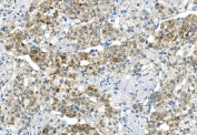 IHC staining of FFPE human renal carcinoma with DR6 antibody. HIER: boil tissue sections in pH8 EDTA for 20 min and allow to cool before testing.