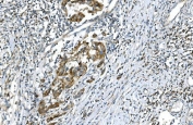 IHC staining of FFPE human bladder cancer with DR6 antibody. HIER: boil tissue sections in pH8 EDTA for 20 min and allow to cool before testing.