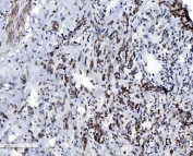 IHC staining of FFPE human breast cancer with VDAC3 antibody. HIER: boil tissue sections in pH8 EDTA for 20 min and allow to cool before testing.