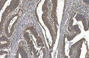 IHC staining of FFPE human rectal cancer with YTHDF2 antibody. HIER: boil tissue sections in pH8 EDTA for 20 min and allow to cool before testing.