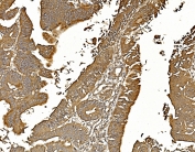 IHC staining of FFPE human rectal cancer with PPP2CA antibody. HIER: boil tissue sections in pH8 EDTA for 20 min and allow to cool before testing.