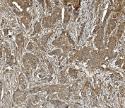 IHC staining of FFPE human breast cancer with PPP2CA antibody. HIER: boil tissue sections in pH8 EDTA for 20 min and allow to cool before testing.