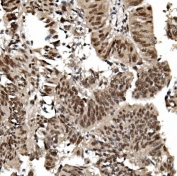 IHC staining of FFPE human rectal cancer with TRIM33 antibody. HIER: boil tissue sections in pH8 EDTA for 20 min and allow to cool before testing.