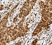 IHC staining of FFPE human breast cancer with TRIM33 antibody. HIER: boil tissue sections in pH8 EDTA for 20 min and allow to cool before testing.