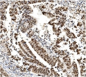 IHC staining of FFPE human rectal cancer with MCM2 antibody. HIER: boil tissue sections in pH8 EDTA for 20 min and allow to cool before testing.